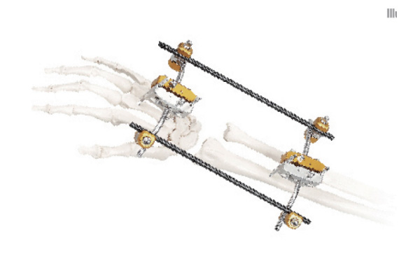 尺桡骨胯关节型