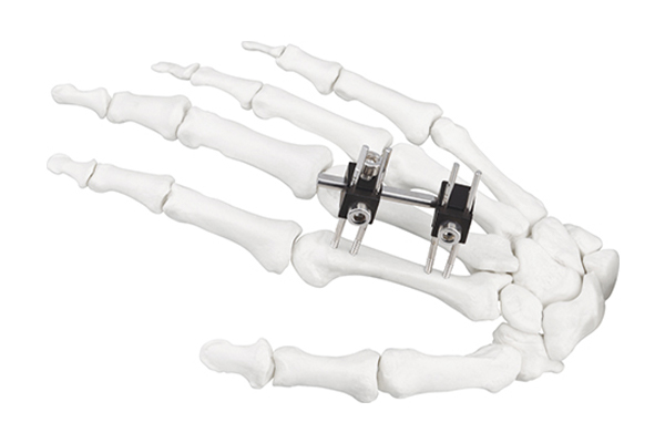 Mini fixator joint motion type