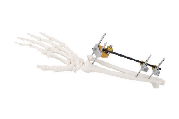 Ulna & Radius fixator1