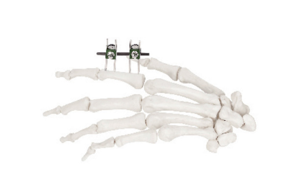 Mini-fixator ( Finger & Palm )