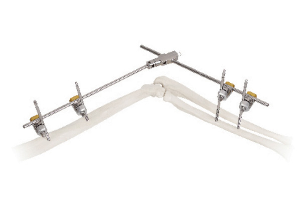 Elbow joint fixator
