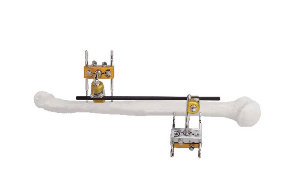 Humeral shaft external fixator