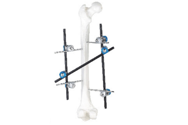 Femoral shaft fixator
