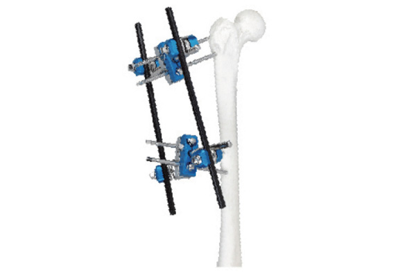 Proximal femur fixator